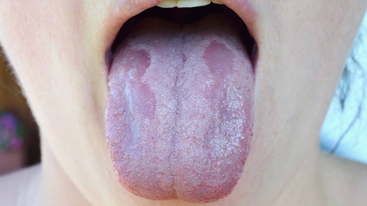 Candida’s Connection to Anxiety and Depression